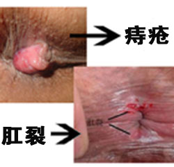 肛裂和痔瘡的區(qū)別.jpg