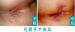 肛瘺術前術后.jpg