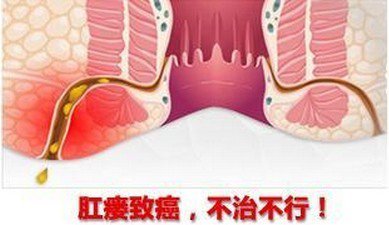 肛瘺致癌.jpg
